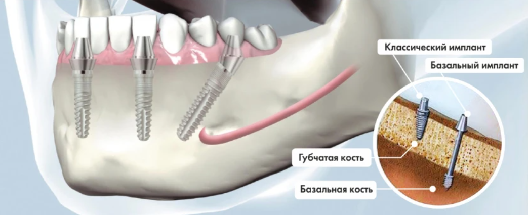 мифы об имплантации зубов
